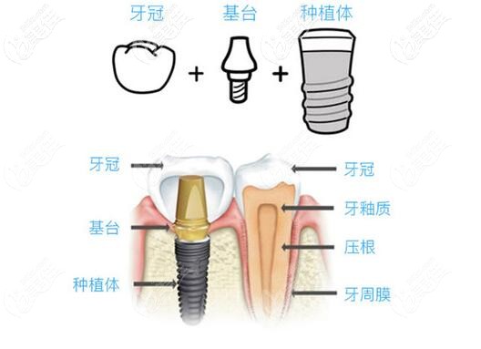 蘭州皓亞口腔種植牙