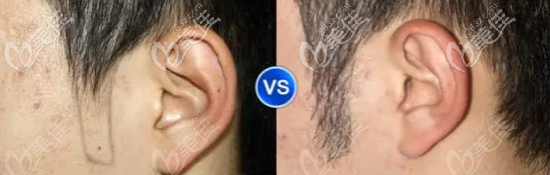 鬢角種植前后對比圖