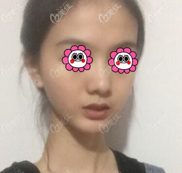 厚唇改薄術后3天照 厚唇改薄術后3天照