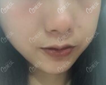 做厚唇改薄術后10天效果照 做厚唇改薄術后10天效果照