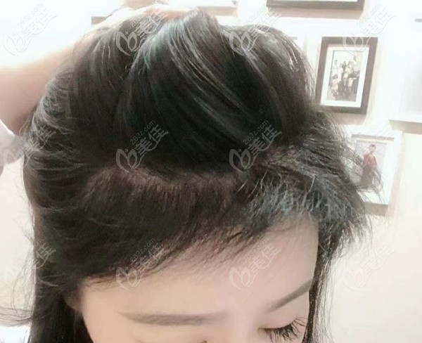 深圳鵬程發(fā)際線植發(fā)6個月效果圖