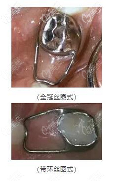 牙齒間隙保持器的不同類型 牙齒間隙保持器的不同類型