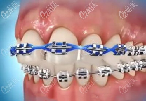 正畸橡皮鏈 正畸橡皮鏈