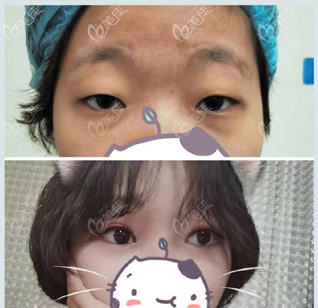 廣東省<!--<i data=20240703-sp></i>-->趙成利醫(yī)生雙眼皮開眼角<span style= 廣東省<!--<i data=20240703-sp></i>-->趙成利醫(yī)生雙眼皮開眼角<span style=