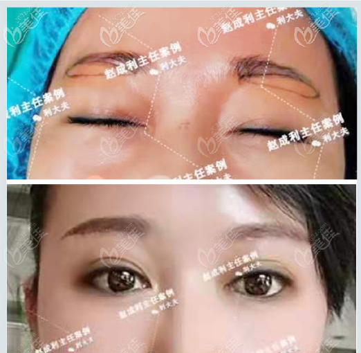 廣州趙成利醫(yī)生雙眼皮眼綜合<span style= 廣州趙成利醫(yī)生雙眼皮眼綜合<span style=