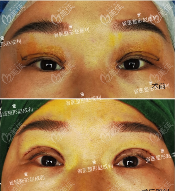 廣州趙成利醫(yī)生埋線雙眼皮失敗修復<span style= 廣州趙成利醫(yī)生埋線雙眼皮失敗修復<span style=