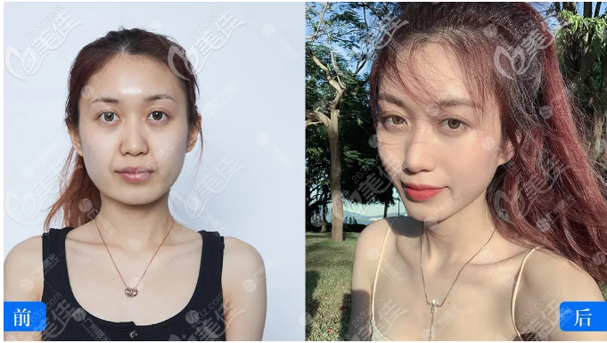 在廣州曙光做完熱瑪吉的小姐姐反饋臉小了一圈