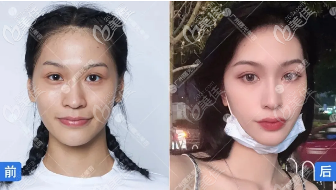 廣州曙光熱瑪吉真人案例效果