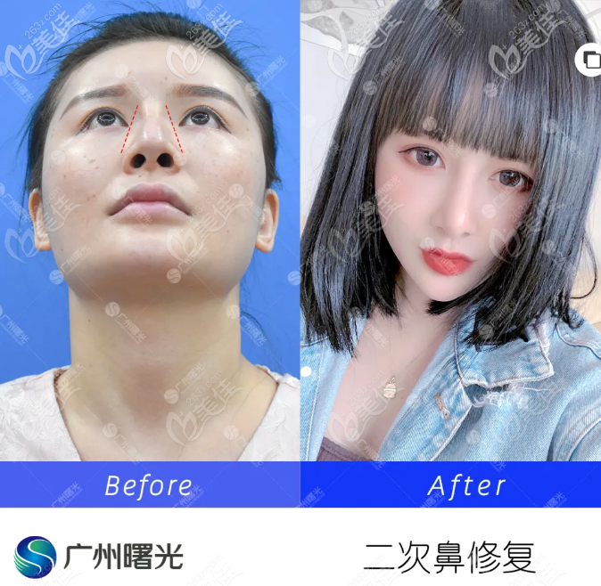 廣州曙光王旭明二次鼻修復案例