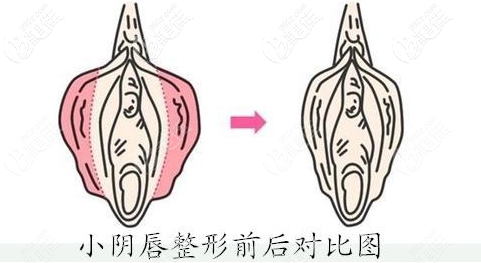 陰唇手術(shù)動(dòng)畫圖