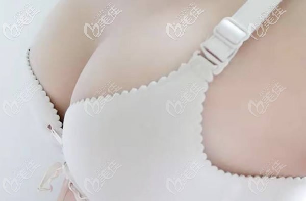 曼托假體隆胸300cc<span style=