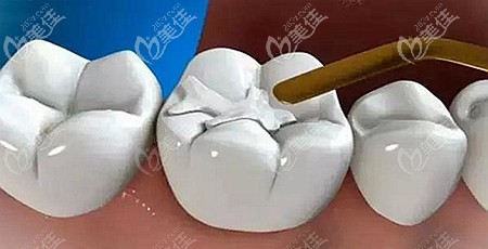 補(bǔ)牙用的樹(shù)脂材料