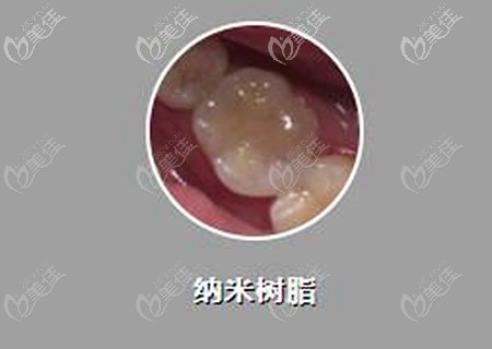 美國(guó)3M納米樹(shù)脂補(bǔ)牙價(jià)格