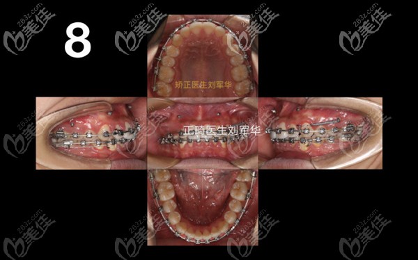 支抗釘前移上頜效果