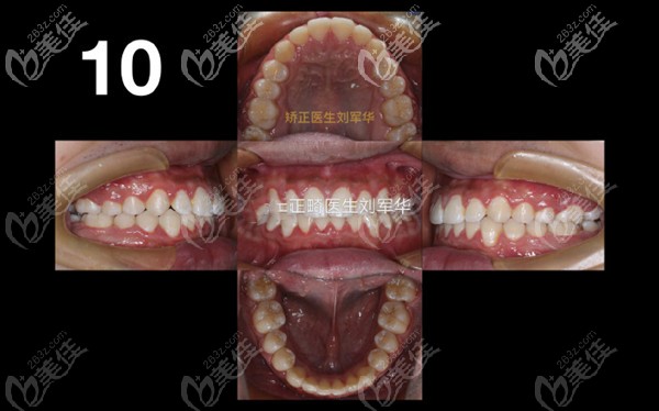 我戴了3年金屬自鎖托槽并種植支抗釘輔助遠(yuǎn)移上頜全牙列，解決了擁擠牙齒