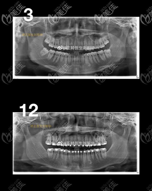 矯正后ct圖對比