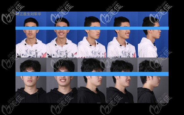 矯正前后效果對比