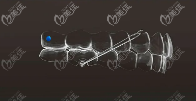 我剛才不小心把正畸橡皮圈吃到肚子里去了怎么辦？