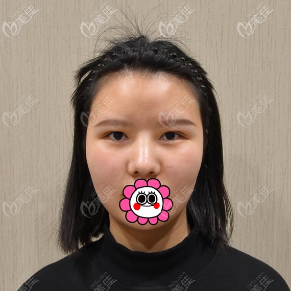 雙眼皮不明顯找俞國寶做修復(fù) 雙眼皮不明顯找俞國寶做修復(fù)