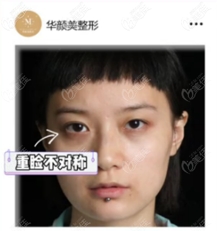 7毫米的雙眼皮 7毫米的雙眼皮