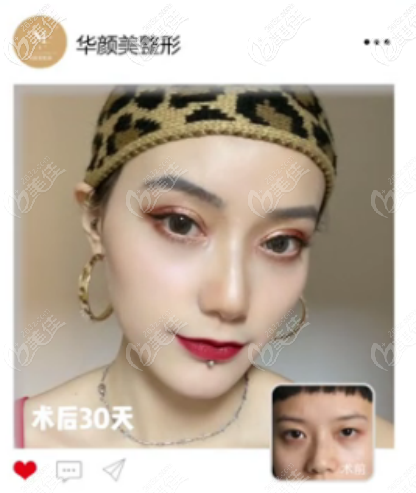 通過(guò)青島華顏美醫(yī)院的案例論證孫好杰做全切雙眼皮怎么樣？