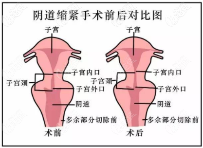 陰道縮緊動畫圖 陰道縮緊動畫圖