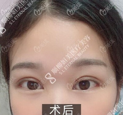 雙眼皮術(shù)后半個月恢復(fù)效果