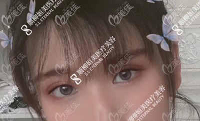 5個(gè)月前找楊小順割的6.5mm扇形雙眼皮沒有肉條感,價(jià)格還不貴