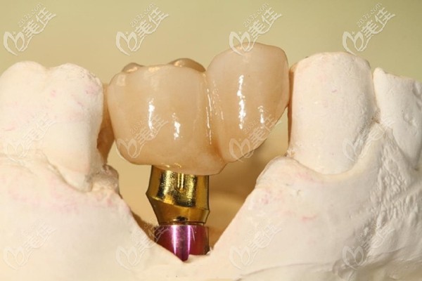 一顆種植體上面戴兩顆牙冠 一顆種植體上面戴兩顆牙冠