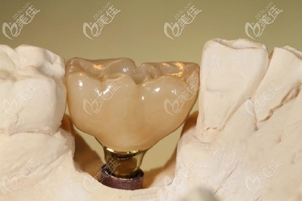 一個(gè)牙釘承載兩個(gè)牙冠 一個(gè)牙釘承載兩個(gè)牙冠