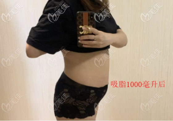 初次腰腹吸脂術(shù)后照片 初次腰腹吸脂術(shù)后照片