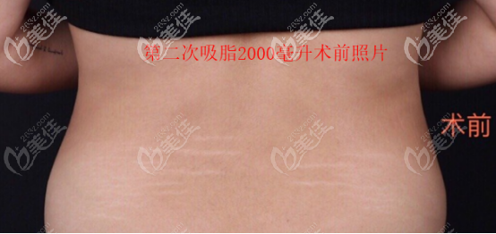 第二次吸脂前照片 第二次吸脂前照片
