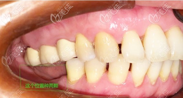 種牙前的口內(nèi)照 種牙前的口內(nèi)照