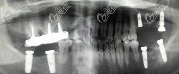 一下子在廣州馬瀧齒科做了6顆種植牙,費(fèi)用真是比活動假牙貴許多