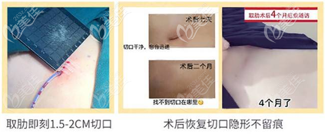 深圳素仁張中峰肋軟骨隆鼻取肋骨不留疤 深圳素仁張中峰肋軟骨隆鼻取肋骨不留疤