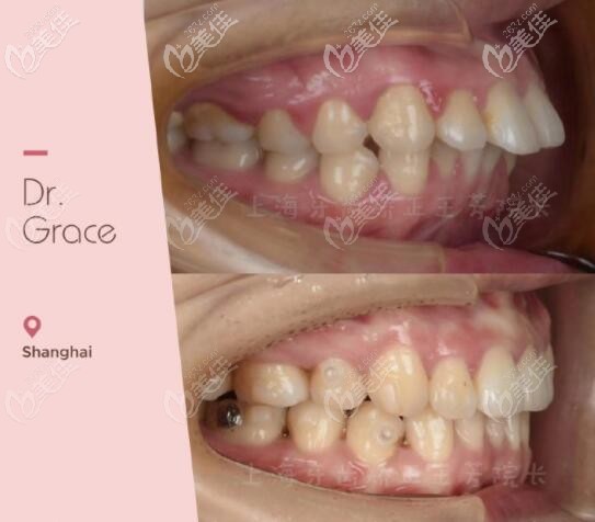 骨性齙牙+露齦笑矯正效果 骨性齙牙+露齦笑矯正效果
