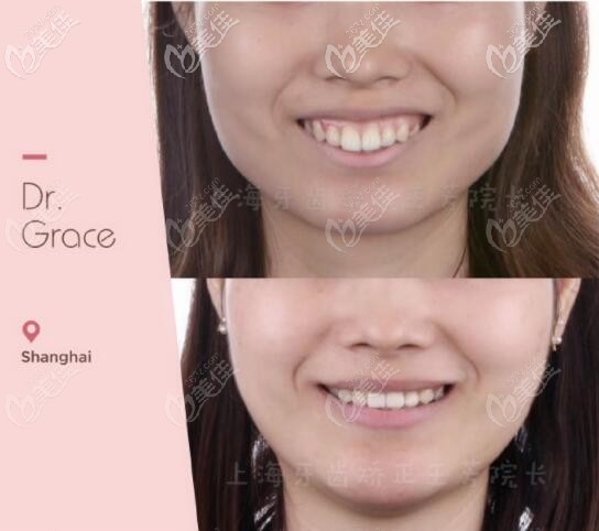 講述我的重度骨性齙牙+露齦笑戴隱適美牙套矯正的案例，沒做正頜手術(shù)只是因?yàn)檎覍?duì)了醫(yī)生