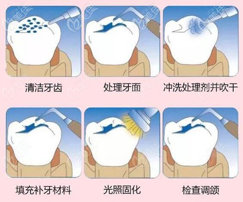 樹脂補(bǔ)牙過程