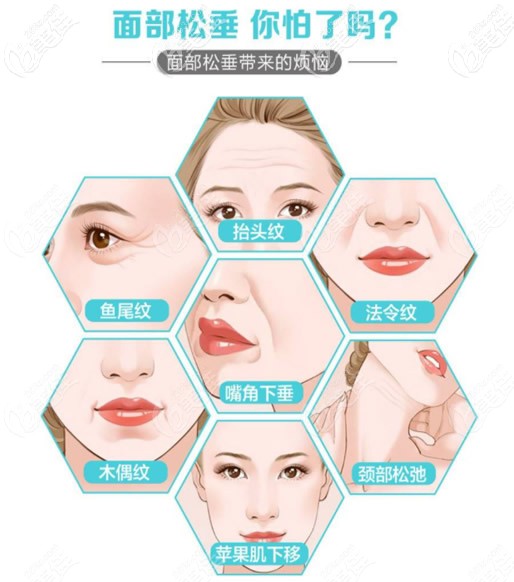 小切口面部提升適合的人群 小切口面部提升適合的人群