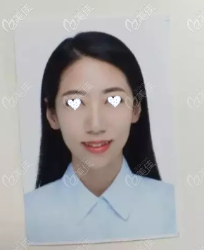 隱適美牙套矯正5個月效果圖 隱適美牙套矯正5個月效果圖