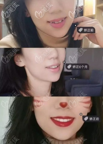 戴隱形牙套6-16個月變化圖 戴隱形牙套6-16個月變化圖