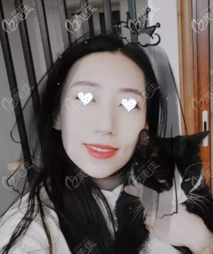 虎牙矯正戴隱適美隱形牙套1-16個月變化圖，戴了3副見效