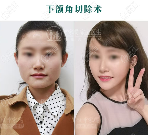 下頜角<span style= 下頜角<span style=