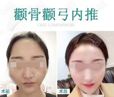 廣州聶云飛磨骨技術(shù)怎么樣?剛從醫(yī)院拿到一份聶云飛顴骨下頜角案例