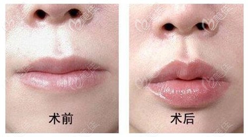 玻尿酸豐唇縮短人中效果對比