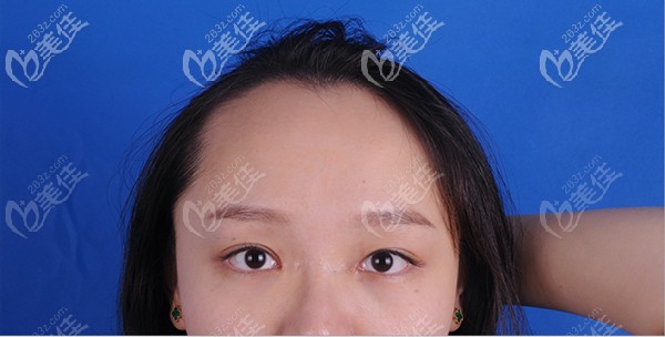 小姐姐發(fā)際線種植術(shù)前發(fā)際線很高 小姐姐發(fā)際線種植術(shù)前發(fā)際線很高