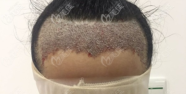 廣州天姿發(fā)際線種植術(shù)后即刻效果 廣州天姿發(fā)際線種植術(shù)后即刻效果