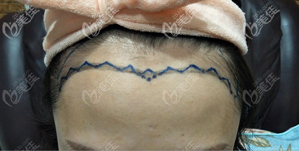 跟醫(yī)生協(xié)商后設(shè)計(jì)的發(fā)際線形狀 跟醫(yī)生協(xié)商后設(shè)計(jì)的發(fā)際線形狀