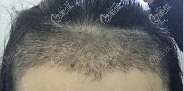 女生發(fā)際線越來越高怎么辦？她選擇在廣州天姿種發(fā)際線讓額頭縮窄3厘米
