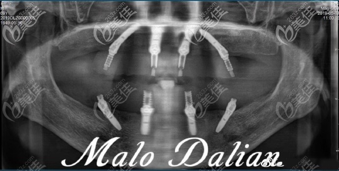 王大爺做了allon4種植牙后的CT照 王大爺做了allon4種植牙后的CT照